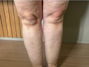 O lipedema é uma doença vascular crônica, com causas genéticas, que se caracteriza por ser o acúmulo desproporcional de gordura, principalmente em braços e pernas.
